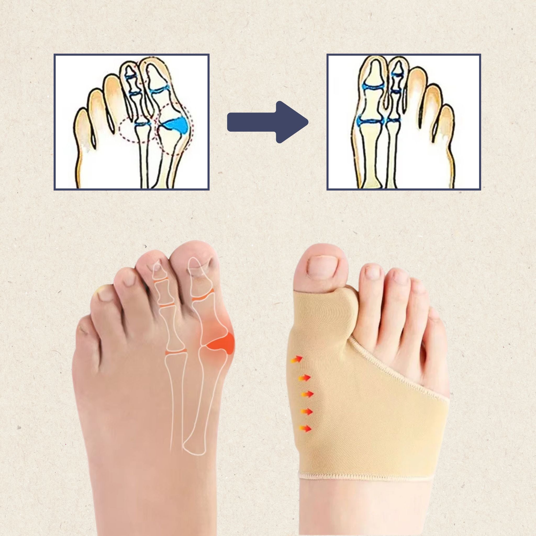 HalluxFit Bandage