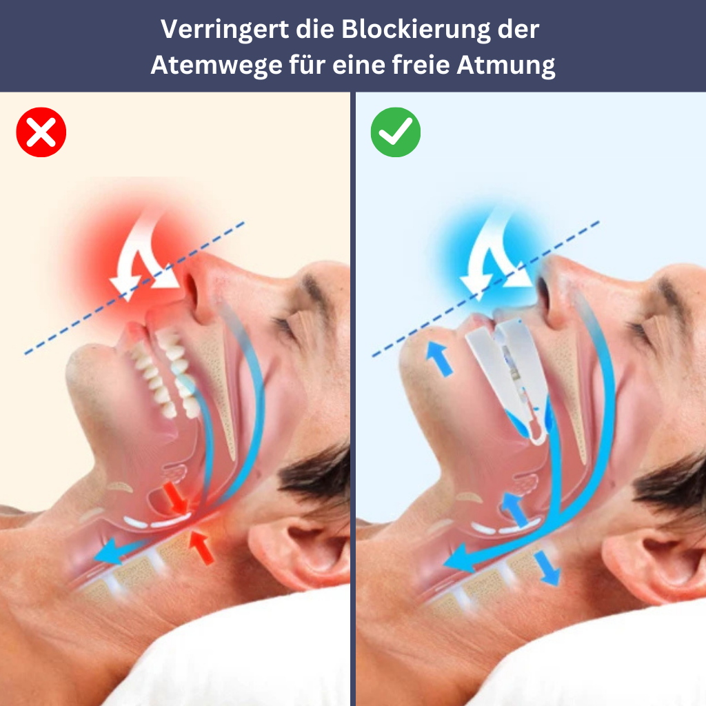 SilentNight - Schnarch- & Protrusionsschiene